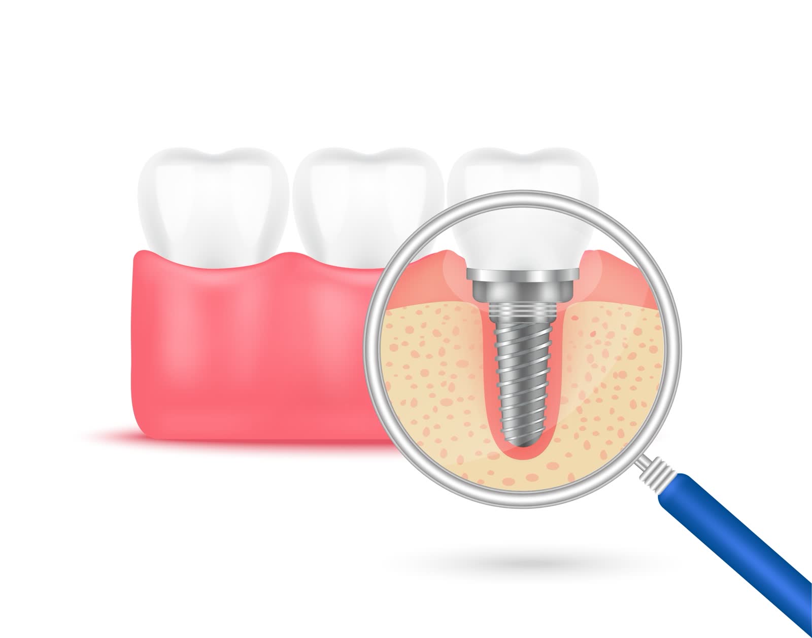 Dental implants treatment in Saginaw